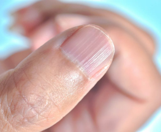 Чому нігті стають ребристими: важливий знак